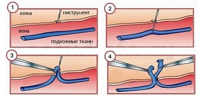 Минифлебэктомия